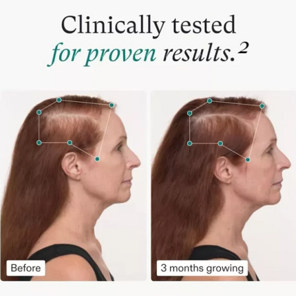 Nutrafol Women’s Balance – Clinically Proven Hair Growth for Women 45+